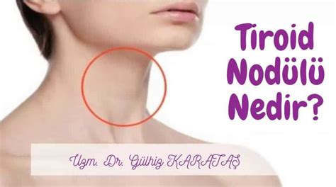 tiroid nodül hangi doktor